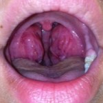 Abnormal Tonsils